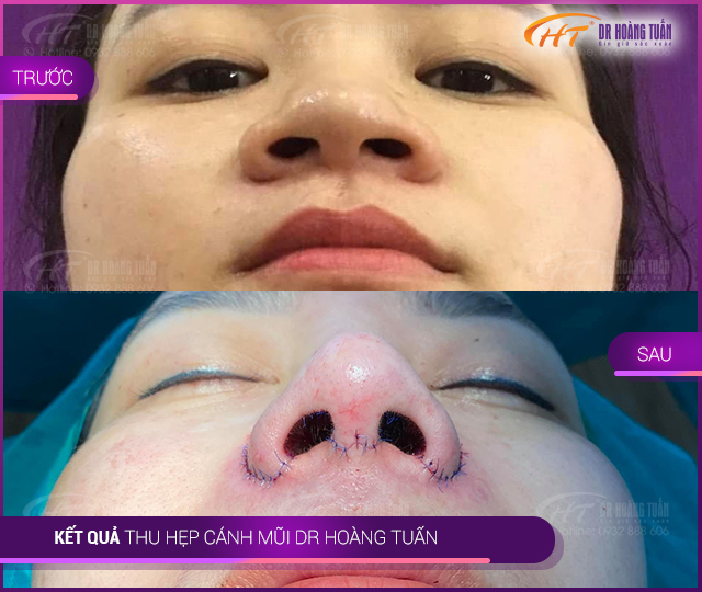 Kết quả phẫu thuật làm gọn cánh mũi 